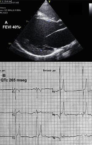 Ecocardiografía (A) y electrocardiografía (B) antes del tratamiento. FEVI: fracción de eyección del ventrículo izquierdo.