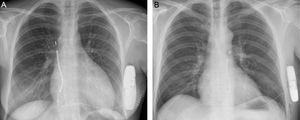 Radiografía de tórax de una paciente con implante del cable a nivel paraesternal derecho (A) y un paciente con implante paraesternal izquierdo (B).