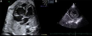 A: ecocardiografía fetal en la que se observa dilatación del ventrículo derecho con aspecto trabeculado. B: ecocardiografía posnatal en la que se puede ver las profundas trabeculaciones del ventrículo izquierdo, que cumple criterios de ausencia de compactación.