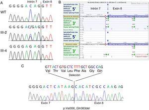 Estudios genéticos. A: cromatograma de secuenciación genómica que muestra la variante c.1066-3C>G en un control normal (WT, panel superior), una portadora homocigota (III-2, panel central) y un varón afectado hemicigoto (III-4, panel inferior); se indica el límite entre el intrón 7 y el exón 8. B: predicciones de corte y empalme realizadas in silico que muestran la consecuencia de la variante en el lugar aceptor del intrón 7; obsérvese que existe un lugar aceptor críptico fuerte localizado a 24 pb distalmente en el exón 8. C: secuenciación del ADNc en el paciente III-4 que muestra la abolición real del lugar aceptor de corte y empalme canónico en el intrón 7 en el ADNc mutante y la utilización del lugar aceptor distal alternativo en el exón 8; esto da lugar a una deleción en el marco de lectura de 24 pb (8 aminoácidos). Esta figura se muestra a todo color solo en la versión electrónica del artículo.