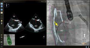 Imagen de fusión ecocardiografía-fluoroscopia para la punción transeptal. El panel de la izquierda muestra una ecografía transesofágica biplanar típica, en la que se aprecia el eje superoinferior (imagen de la izquierda, proyección bicava) y el eje anteroposterior (imagen de la derecha). En el panel de la derecha, la proyección bicava obtenida en la ecocardiografía transesofágica se superpone a la imagen fluoroscópica en vivo para producir la fusión de ecocardiografía y fluoroscopia. La totalidad del catéter transeptal (flecha amarilla) se visualiza bien mediante la fluoroscopia, pero no se aprecia bien en la ecocardiografía bidimensional. La fusión de las imágenes de ecocardiografía y fluoroscopia proporciona una visualización simultánea del catéter transeptal y la anatomía relevante de los tejidos blandos aportada por la ecocardiografía en una sola imagen y orientación. En este caso, también se colocó en el espacio ecocardiográfico una marca de referencia empleando ecografía biplanar (círculos rojos, imagen de la izquierda) y esta marca se transfirió automáticamente al espacio fluoroscópico (círculo rojo, imagen de la derecha). AD: aurícula derecha; AI: aurícula izquierda; VCS, vena cava superior. Esta figura se muestra a todo color solo en la versión electrónica del artículo.
