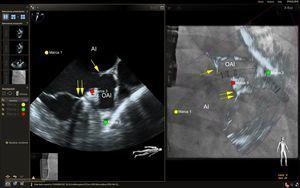 Imagen de fusión ecocardiografía-fluoroscopia para la oclusión de la orejuela auricular izquierda. En el panel izquierdo se muestra una proyección mesoesofágica de la orejuela auricular izquierda a un ángulo multiplanar de 73°. En esta proyección se observa también el borde de cumadina (flecha simple) y el anillo mitral (flechas dobles). En el panel de la derecha se muestra una imagen de fusión ecocardiografía bidimensional (2D)-fluoroscopia desde un ángulo de fluoroscopia oblicuo anterior de 29°. El catéter guía se observa mediante la fluoroscopia, y se aprecia que atraviesa el lugar de punción transeptal (círculo amarillo), y la anatomía de los tejidos blandos pertinentes se aprecia mediante la ecocardiografía que se fusiona casi en tiempo real (panel de la derecha). Se colocaron marcas de referencia en el lugar óptimo de punción transeptal (círculo amarillo), la arteria coronaria circunfleja izquierda (círculo rojo) y la punta de la orejuela auricular izquierda (círculo verde). Obsérvese que, en la imagen de fusión de la derecha, el catéter guía aparece apoyado en la punta de la orejuela auricular izquierda cuando se examina la superposición de la imagen de ecocardiografía 2D. Sin embargo, esto se debe al escorzo de la orejuela, ya que el vértice real de esta quedaba fuera del plano de imagen 2D. La verdadera punta de la orejuela auricular izquierda, marcada con el círculo verde, está en una posición más distal de lo que podría parecer con la imagen 2D sola. AI: aurícula izquierda; OAI: orejuela auricular izquierda. Esta figura se muestra a todo color solo en la versión electrónica del artículo.