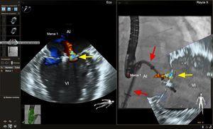 Imagen de fusión ecocardiografía-fluoroscopia para la reparación percutánea de la válvula mitral (MitraClip). En el panel de la izquierda se muestra una proyección comisural de la válvula mitral con imágenes de Doppler color que muestran el origen del chorro de regurgitación mitral (flecha amarilla). En el panel de la derecha se muestra una proyección oblicua anterior derecha del catéter guía y el dispositivo MitraClip con fusión en vivo de la imagen de ecocardiografía Doppler color bidimensional en el lado izquierdo. Obsérvese que las posiciones del catéter guía y el dispositivo no se aprecian bien en la imagen de ecocardiografía de la izquierda. La imagen de fusión ecocardiografía-fluoroscopia del lado derecho muestra el catéter guía y su posición respecto al chorro de regurgitación, lo cual facilita ajustar con precisión la posición del clip o la colocación de un segundo clip. AI: aurícula izquierda; VI: ventrículo izquierdo. Esta figura se muestra a todo color solo en la versión electrónica del artículo.