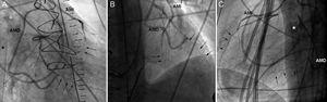 Angiografía posoperatoria oblicua izquierda (A), posteroanterior (B) y lateral (C). Se aprecian AMD y AMI permeables y espasmo difuso del árbol coronario distal a las anastomosis (flechas). Cánula venosa del oxigenador extracorpóreo de membrana (asterisco). AMD: injertos de mamaria derecha; AMI: injertos de mamaria izquierda.