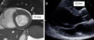 Ejemplo de miocardiopatía hipertrófica no detectada en la ecocardiografía (A) y que se visualiza en la cardiorresonancia magnética (B).
