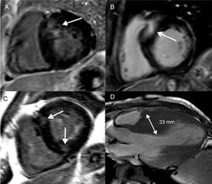 Fibrosis focal en la miocardiopatía hipertrófica. Cortes del ventrículo izquierdo de eje corto (A-C) y un corte apical de eje largo (D) que muestran distintos patrones de RTG y engrosamiento de la pared del VI en la miocardiopatía hipertrófica. A: engrosamiento basal y septal del VI y colocalización del RTG. B: localización basal y septal más extensa del RTG, lo que representa un mayor riesgo de MSC. C: RTG en las uniones anterior e inferior derechas del VI, lo que no se relaciona con un aumento del riesgo de MSC. D: patrón medioventricular de engrosamiento del VI, con un septo interventricular de 33 mm; tanto la hipertrofia medioventricular como el engrosamiento del VI ≥ 30 mm son marcadores del riesgo de MSC. MSC: muerte súbita cardiaca; RTG: realce tardío de gadolinio; VI: ventrículo izquierdo.