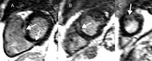 Resonancia magnética cardiaca en la sarcoidosis cardiaca y riesgo de arritmias ventriculares y muerte súbita cardiaca. Cortes del ventrículo izquierdo de eje corto (A-C) que muestran realce tardío de gadolinio en la pared media y el epicardio (flechas) a nivel basal (A), medioventricular (B) y apical (C) en un paciente con sarcoidosis cardiaca. En esta enfermedad, tanto la presencia como la extensión del realce tardío de gadolinio se relacionan con arritmias ventriculares y muerte súbita cardiaca.