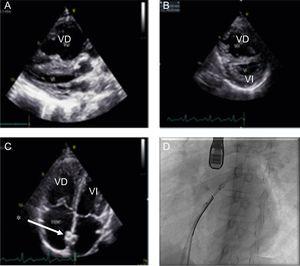 A: ecocardiografía; se observa la dilatación del VD que comprime el VI. B: TIV de tipo IV y alteración del índice de esfericidad, signos ecocardiográficos de HP grave. C: imagen del stent (*) correctamente posicionado. D: cateterismo; colocación del stent guiado por ETE. ETE: ecocardiografía transesofágica; TIV: tabique interventricular; VD: ventrículo derecho; VI: ventrículo izquierdo.