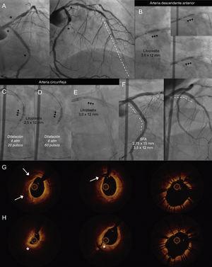 A: lesiones calcificadas en CX ostial y medio-distal y DA ostial (asterisco) con enfermedad difusa en el vaso distal de la DA (línea discontinua). Litoplastia coronaria con balón de 3 mm en la DA ostial (B) y en la CX medio-distal a 4 atm, 20 pulsos (C), 60 pulsos (D) y ostial (E). F: implante de 3 SFA, con buen resultado; imágenes de OCT previas a la LC; rotura de placa cálcica (flecha) y disección de placa fibrosa (asterisco). G y H: imágenes tras la LC y el implante de stent en la CX ostial (G) y medio-distal (H). CX: circunfleja; DA: descendente anterior; LC: litoplastia coronaria; OCT: tomografía de coherencia óptica; SFA: stent farmacoactivo.