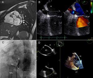 A: resonancia magnética, corte sagital. B: ecocardiografía transesofágica; vista de 4 cámaras que ilustra el ostium del seno coronario y el seno coronario destechado completo (línea de puntos discontinua en la aurícula izquierda). C: angiografía; proyección oblicua anterior izquierda que muestra el catéter pigtail en la aurícula izquierda a través del orificio del seno coronario (asterisco). D: ecocardiografía transesofágica tridimensional; vista desde la aurícula derecha. *: ostium del seno coronario; AD: aurícula derecha; AI: aurícula izquierda; TIPS: shunt transyugular intrahepático portosistémico; VI: ventrículo izquierdo; VT: válvula tricúspide.