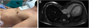 Paciente en decúbito supino (A) e imagen de la resonancia magnética cardiaca (B) en la que se puede apreciar el pectum excavatum.