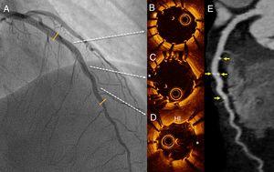 Hallazgos por angiografía (A), tomografía de coherencia óptica (B-D), y tomografía computarizada (E) tras la intervención coronaria percutánea. Superposición de los 2 dispositivos bioabsorbibles (C). HI: hematoma intramural; *: artefacto de la guía.