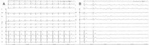 A: electrocardiograma basal con un QRS de 100ms y un patrón de Brugada tipo 3. B: bloqueo auriculoventricular completo sin ensanchamiento previo del QRS.