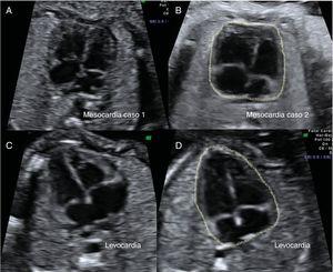 Comparación de la morfología cardiaca. Corte transversal torácico de 2 fetos con mesocardia (A, B) y 2 fetos con levocardia-levoápex (C, D). En los fetos con mesocardia (A, B), el corazón se encuentra en el centro del tórax con una alineación del tabique interventricular con la línea media torácica. En ambos casos, los corazones presentan una morfología cuadrada, en comparación con los fetos con levocardia (C, D), en los que se identifica una morfología triangular.