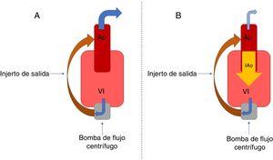 A: funcionamiento normal del dispositivo. B: circuito ineficiente establecido por la IAo. Ao: aorta; IAo: insuficiencia aórtica; VI: ventrículo izquierdo.