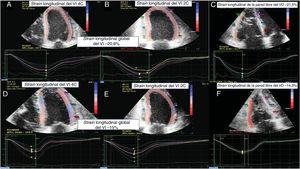 Imágenes de STE de un paciente. A-C: BEM clasificada como de grado 0R. D-F: un episodio de RCA ≥ 2R. De izquierda a derecha: strain longitudinal del VI tetracameral, strain longitudinal del VI bicameral y strain longitudinal de la pared libre del VD. BEM: biopsia endomiocárdica; RCA: rechazo celular agudo; STE: ecocardiografía speckle-tracking bidimensional; VD: ventrículo derecho; VI: ventrículo izquierdo. Esta figura se muestra a todo color solo en la versión electrónica del artículo.