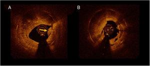 A: presencia intraluminal de material que indica un trombo (flecha). B: forma irregular de la luz.