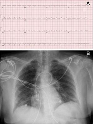 A: electrocardiograma al ingreso; elevación cóncava del ST, descenso del PR y bajos voltajes. B: radiografía de tórax al ingreso.