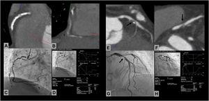 Análisis de correlación entre la tomografía computarizada con multidetectores (TCMD) y la coronariografía invasiva (CI). En la imagen izquierda se muestra una lesión en la coronaria derecha media no valorable en la TCMD de un paciente con puntuación de calcio > 2.000, en el que el quantitative coronary analysis (QCA) detectó una estenosis del 92%. En la imagen derecha puede verse un ejemplo de buena correlación entre la TCMD y el QCA en un paciente con lesión focal de la descendente anterior proximal (flecha).