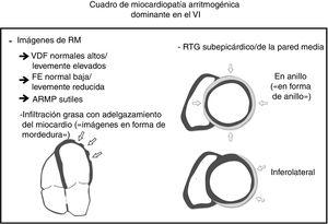 Características distintivas de la resonancia magnética cardiaca en la miocardiopatía arritmogénica. ARMP: anomalías regionales del movimiento de la pared; FE: fracción de eyección; RTG: realce tardío de gadolinio; VDF: volúmenes diastólicos finales; VI: ventrículo izquierdo.