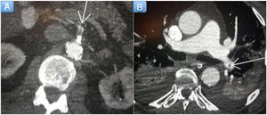 A: tomografía computarizada abdominal; se observa un defecto de repleción en la arteria mesentérica superior, compatible con trombosis arterial (flecha). B: tomografía computarizada de tórax, con hallazgos compatibles con tromboembolia pulmonar (flecha).