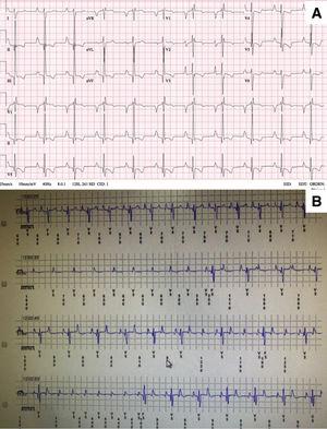 A: electrocardiograma en reposo de la paciente. B: bloqueo auriculoventricular de alto grado intermitente en el monitor cardiaco de bucle continuo.