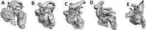 Reproducción estereolitográfica de corazones fetales obtenidos mediante la correlación espaciotemporal de las imágenes. A: D-transposición de grandes vasos (D-TGV). B: comunicación interventricular completa. C: tetralogía de Fallot. D: D-TGV, comunicación interventricular y estenosis pulmonar. E: arco aórtico interrumpido (tipo B). Ao: aorta; AP: arteria pulmonar; VD: ventrículo derecho; VI: ventrículo izquierdo. El asterisco indica la comunicación interventricular.