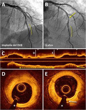 Resultado angiográfico y por tomografía de coherencia óptica de un dispositivo vascular bioabsorbible (DVB) implantado 5 años antes en la arteria descendente anterior (DA). Varón de 83 años a quien, en el año 2013, por angina estable se le implantó un DVB (Absorb) (3 × 18 mm) en una lesión en el segmento distal de la DA (línea discontinua), con excelente resultado (A). En 2018, se repitió la coronariografía por angina estable y se observó persistencia de buen resultado del DVB (línea discontinua) y una lesión de novo en el segmento medio de la DA (flecha) que se trató con un stent farmacoactivo (B). El estudio posterior con tomografía de coherencia óptica revela excelente resultado del stent farmacoactivo recién implantado (C; flecha) y la completa desaparición del DVB (C-E); en dicho segmento coronario solo aparecen (línea discontinua con flechas) una placa fibrosa no obstructiva (D) y las marcas radiopacas residuales (platino) del dispositivo situadas en sus extremos (E; flecha).