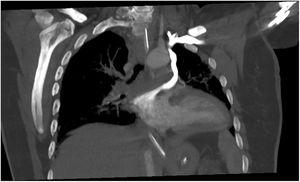 Tomografía computarizada con contraste: sistema venoso unido a la vena pulmonar superior derecha y la pared de la aurícula izquierda.