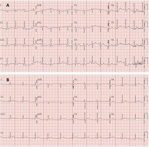 A: electrocardiograma en urgencias. Taquicardia sinusal a 105 lpm, eje normal (90°). PR normal (120 ms). QRS estrecho. Onda Q no significativa en cara inferior. Sin alteraciones agudas de la repolarización. QT corregido en intervalo normal. B: electrocardiograma en consultas de cardiología, 2 días después. Ritmo sinusal a 75 lpm, eje normal. PR normal (120 ms), con descenso del segmento PR. QRS estrecho. Supradesnivelación del segmento ST, cóncava y generalizada. QT corregido en intervalo normal.