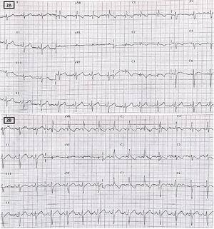 Electrocardiograma durante test con flecainida. A: electrocardiograma basal en posición de Brugada. B: electrocardiograma tras 10 min de infusión de flecainida.