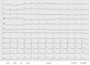 Electrocardiograma en ritmo sinusal con supradesnivelación cóncava y difusa del segmento ST (> 1 mm) y supradesnivelación en el intervalo PR en aVR.