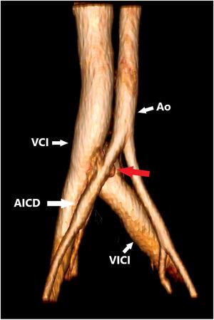 Reconstrucción volumétrica 3D donde se aprecia una fístula arteriovenosa ilioiliaca (flecha roja). AICD: arteria iliaca común derecha; Ao: aorta; VCI: vena cava inferior; VICI: vena iliaca común izquierda.