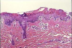 Case 1. Skin biopsy displaying the altered epidermis. Degenerative vacuolar changes are observed in the dermoepidermal junction, accompanied by alterations in the stratified maturation of the acanthocytes. The inflammatory exudate is extremely scarce and is limited to the papillary dermis. Haematoxylin and eosin (H–E) stain, 10×.