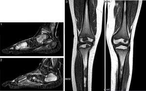 T2W MRI scan of the left foot with fat suppression (STIR) and T1W knee and leg scan. Important replacement of the normal adipose marrow component with nodular images (hypointense in T1W and hyperintense in T2W sequencing with STIR), particularly apparent in the metacarpal region, astragalus, calcaneus, scaphoid bone, both tibias and fibulas, and both femurs – with no radiological evidence of aggressive behaviour. These findings would be consistent with proliferative/dysplastic disease, though other more infrequent disorders such as multifocal osteomyelitis or non-Langerhans cell histiocytosis (Erdheim-Chester disease) cannot be discarded.