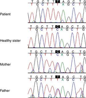 Chromatogram relate to Sanger validation and segregation of the mutation (chr1: 22965784 C>T) in patient, parents and healthy sibling.