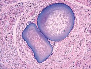 Caso 1. Partículas en el seno del tejido muscular uterino.