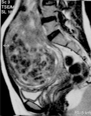 Caso 2. Resonancia magnética tras 6 meses de la embolización. Mioma que alcanza el ombligo.