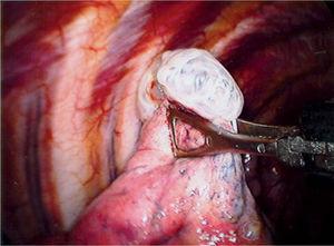 Imagen de videotoracoscopia: la flecha muestra en el vértice pulmonar el bleb responsable del neumotórax.