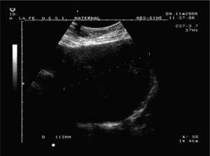 Ecografía del segmento uterino de la paciente 2.