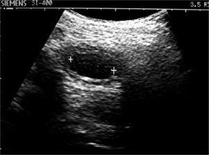 Caso 3. Ectasia urinaria. Sección transversa del uréter dilatado.