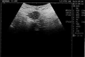 Caso 2. Carcinomatosis peritoneal. Nódulo subumbilical.
