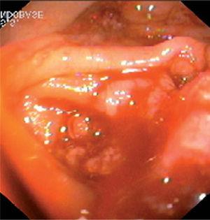 Caso 2. Carcinomatosis peritoneal. Imagen colonoscópica.