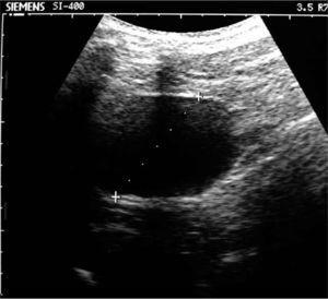 Caso 3. Ectasia urinaria. Pelvis renal izquierda, extrarrenal.