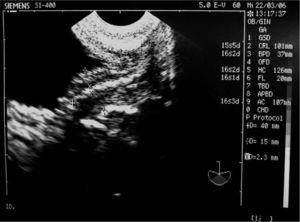 Caso 3. Ectasia urinaria. Útero, endometrio y parte de la vejiga.