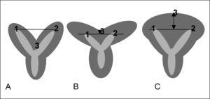 Criterio de diferenciación por ultrasonografía entre un útero septado y otro bicorne. A) Cuando el ápice (3) del contorno externo fundal tiene lugar por debajo de una línea recta entre la ostia tubal (1, 2) o B) cuando el ápice es < 5mm el útero es bicorne. C) Cuando el ápice es > 5mm por encima de la línea, el útero es septado.