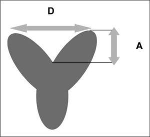 Diagrama de la ratio del útero arcuato. Con una ratio A (altura de la indentación fundal)/D (distancia entre los ápices de los cuernos) < 10% los resultados reproductivos no se ven afectados.