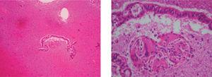 A) Lámina de epitelio endometrial con agregado histiocitario. B) A mayor aumento, se evidencia granuloma con células multinucleadas y en la cercanía una lámina de epitelio endometrial superficial sin atipias.