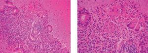 A) Englobado por material mucinoso con restos celulares y neutrófilos, se observa agregado de células histiocitarias en el estroma endometrial. B) A mayor aumento, las células histiocitarias de tipo Langerhans, en la vecindad de las glándulas en el estroma endometrial.