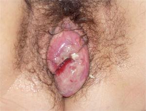 Prolapso genital (ampliación de la imagen).